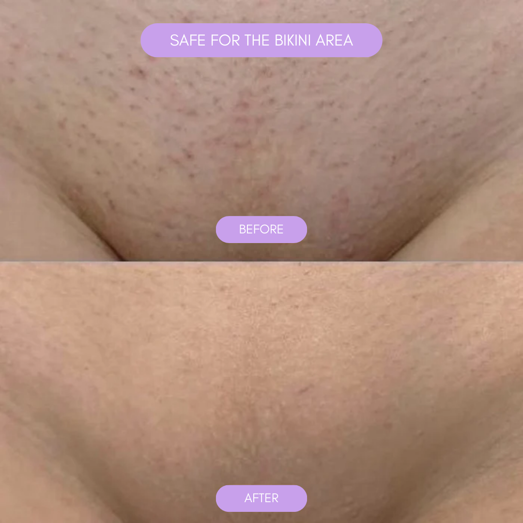 BowLift | Hair removal device for smooth soft skin