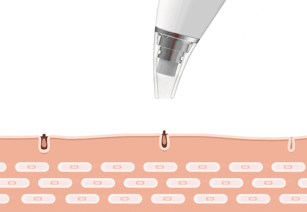 BowLift | Blackhead Remover Vacuum Pore Cleanser Tool