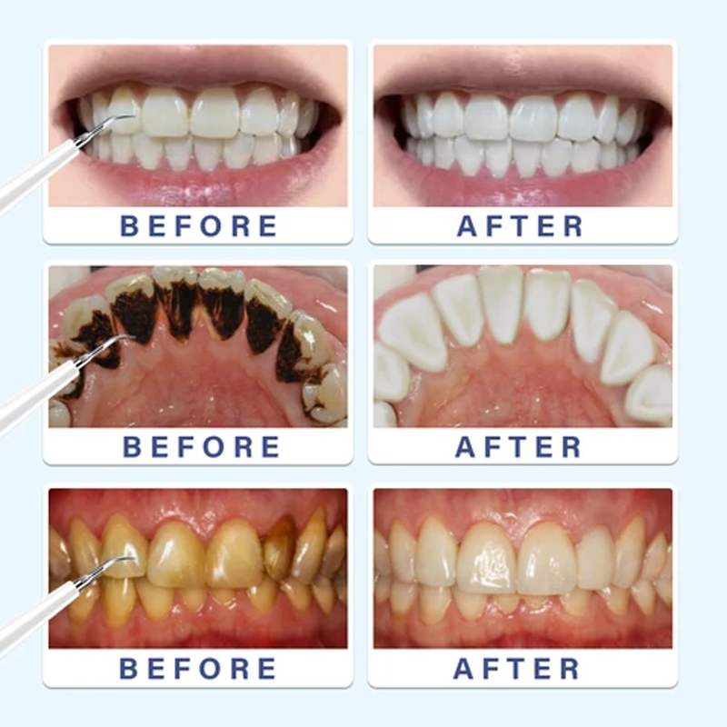 BowLift | Electric Toothbrush Tartar Removal Set