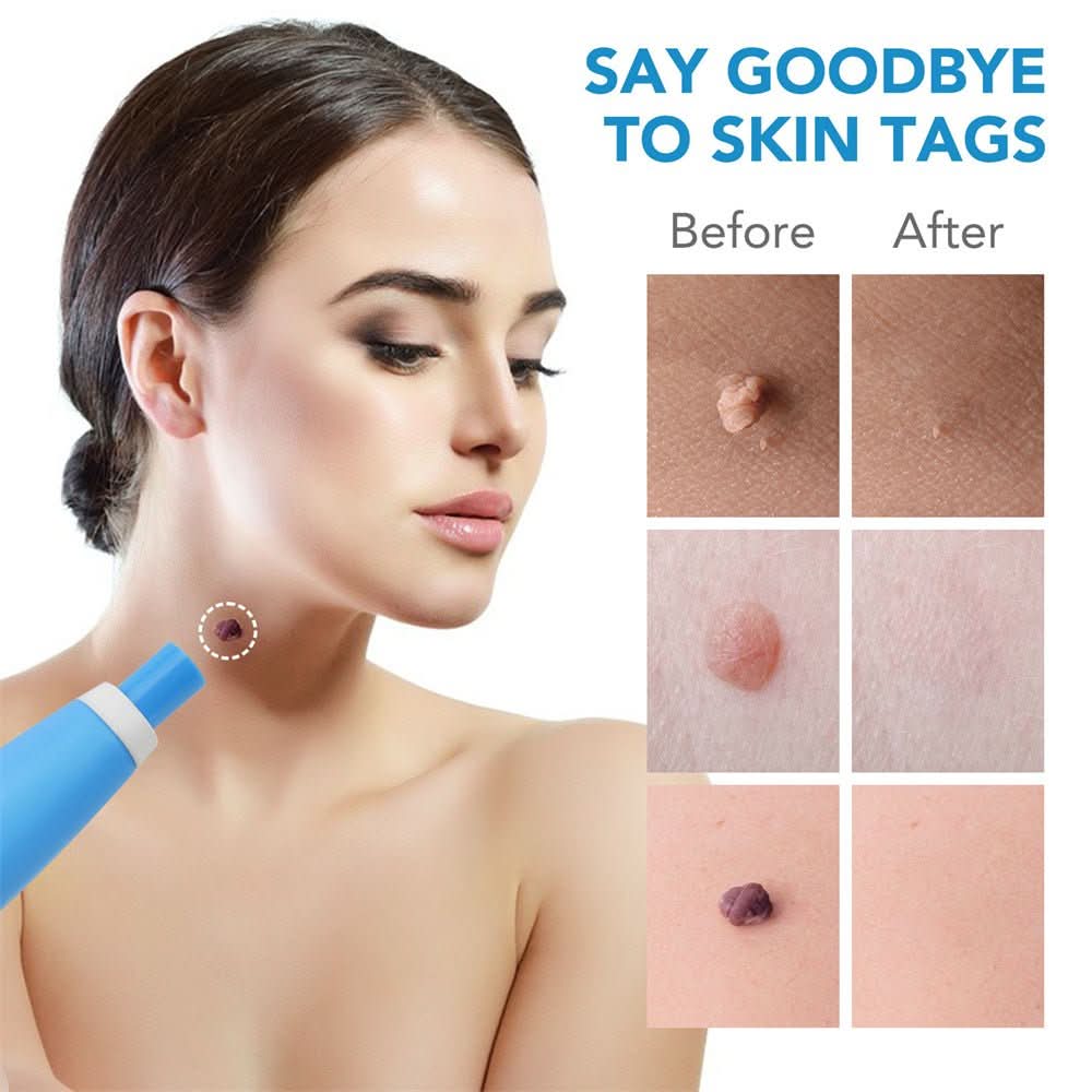 BowLift | Skin spot remover for warts & skin tags