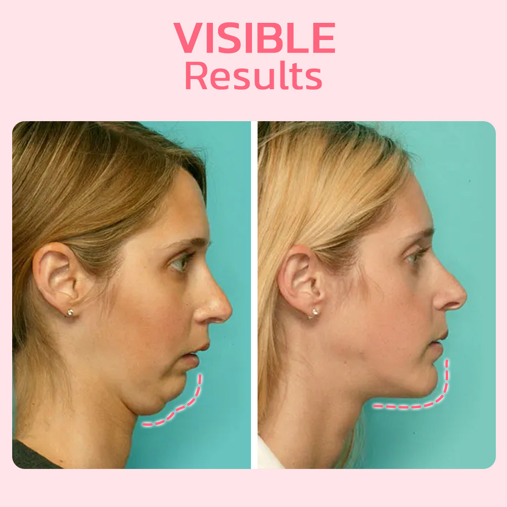 BowLift | FaceSuction Enhanced Facial Definition