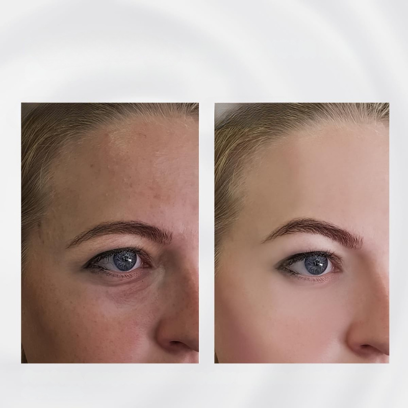 BowLift | Facial Roller Stainless Steel Puffiness Massager