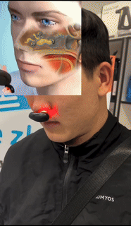 BowLift | Infrared Rhinitis Laser Device