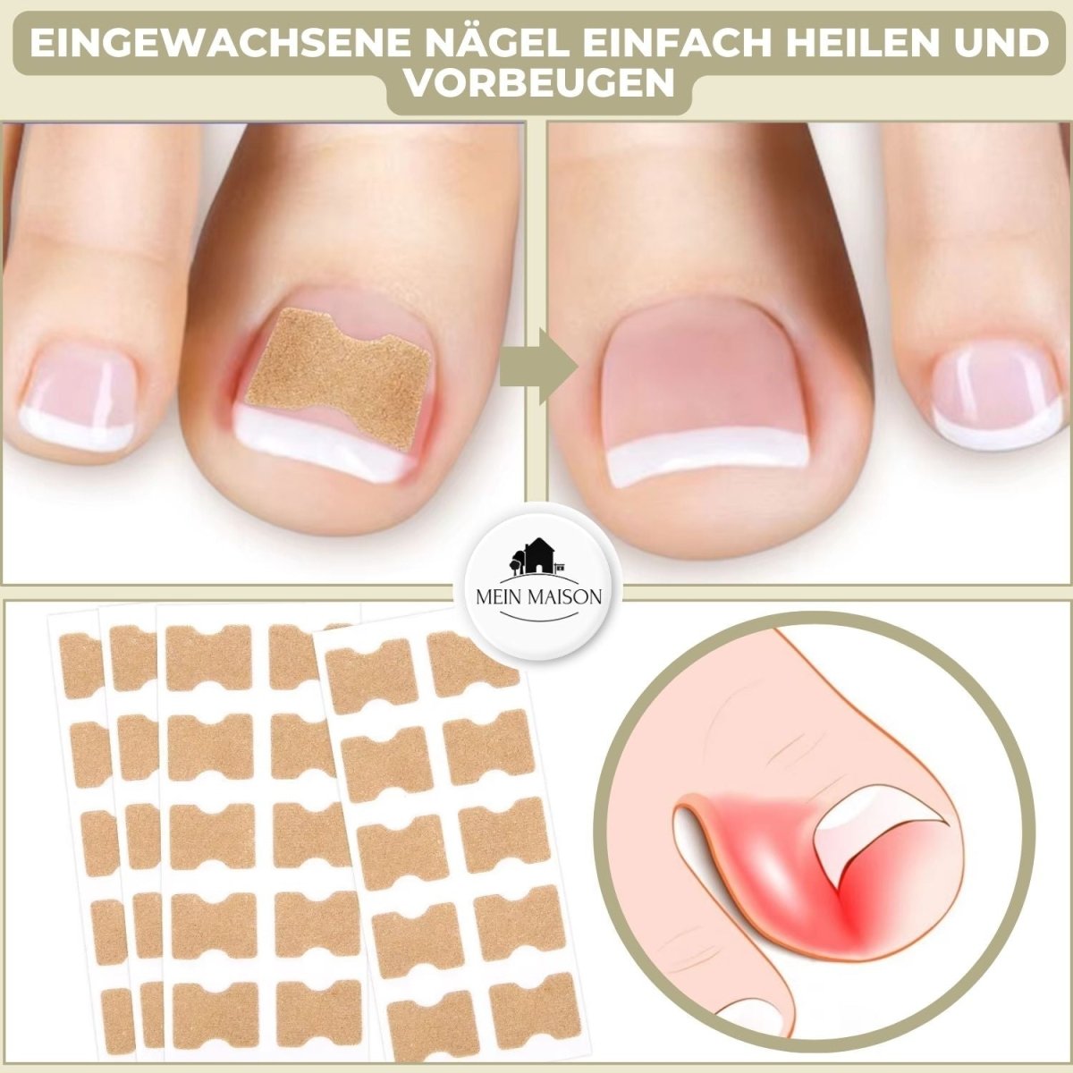 BowLift | ALIGNSTRIP – Painless Nail Correction Strips for Ingrown & Deformed Nails