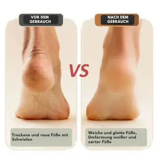 BowLift | Mivoza Electric Callus Remover — Free your feet and enjoy silky smooth lightness with every step!