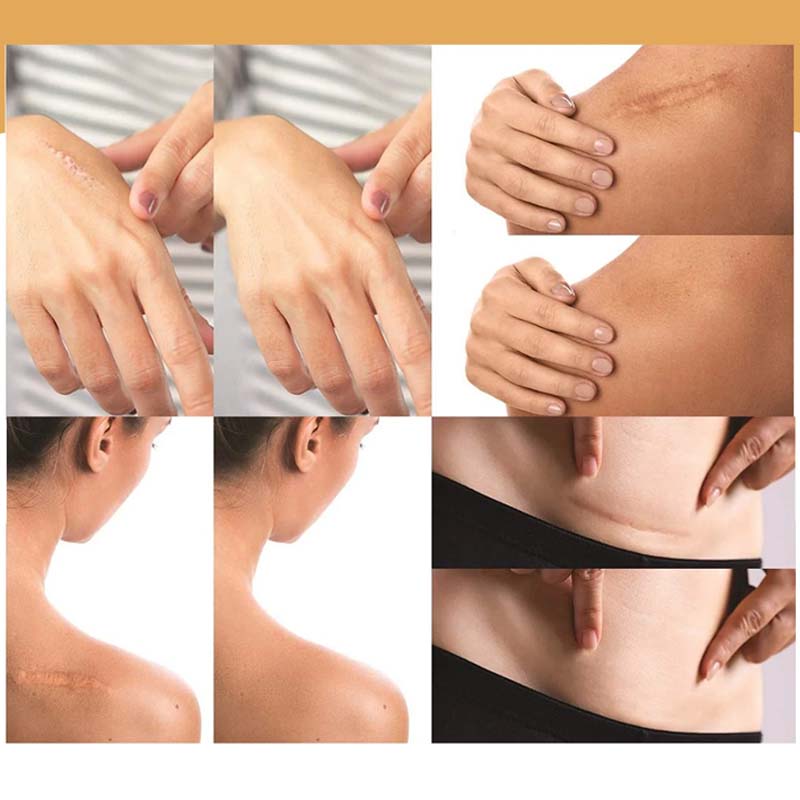 BowLift | Skin Invisible Concealer Patch
