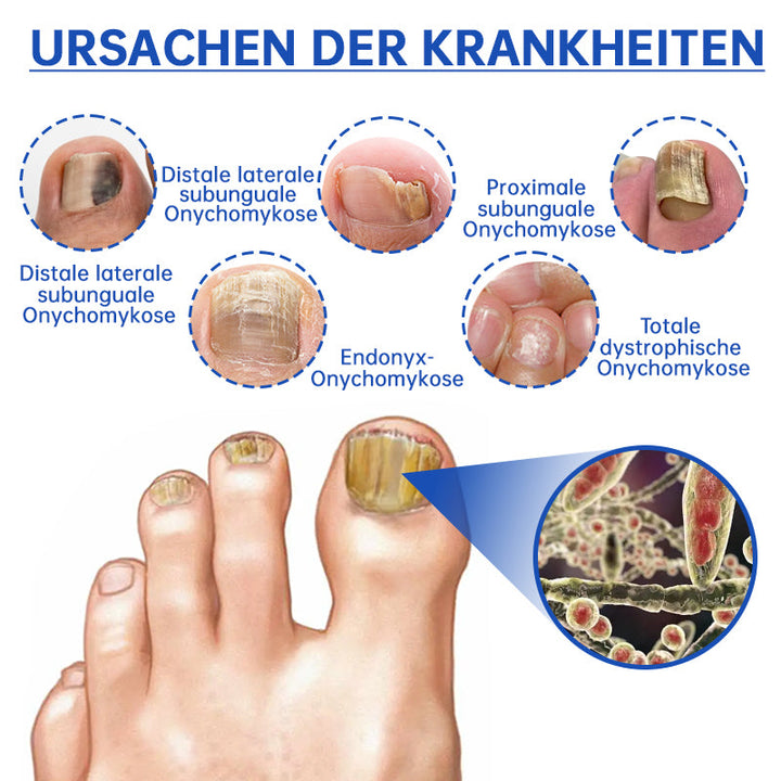 BowLift | PureNail™ | Nail Fungus Laser Therapy Device - Your Secret Weapon Against Nail Fungus