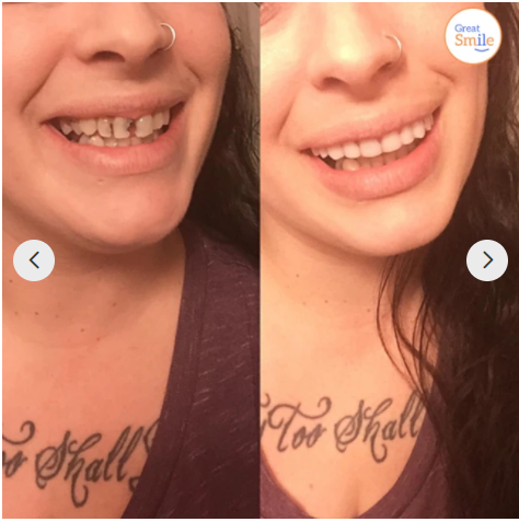 BowLift |  - Snap-in Dental Prosthesis | 1+1 FREE!