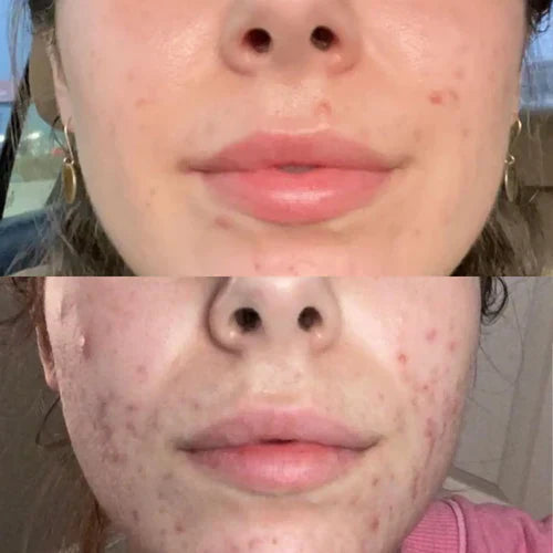 BowLift | LumiGlow - Pain-Free Treatment: Non-Invasive Therapy