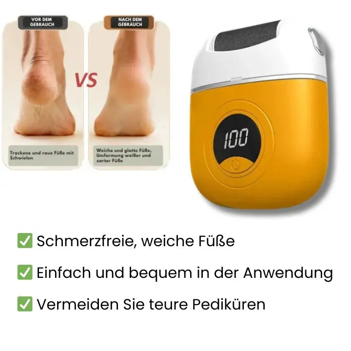 BowLift | Mivoza Electric Callus Remover — Free your feet and enjoy silky smooth lightness with every step!