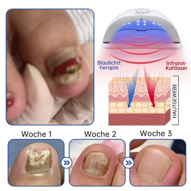 BowLift | PureNail™ | Nail Fungus Laser Therapy Device - Your Secret Weapon Against Nail Fungus