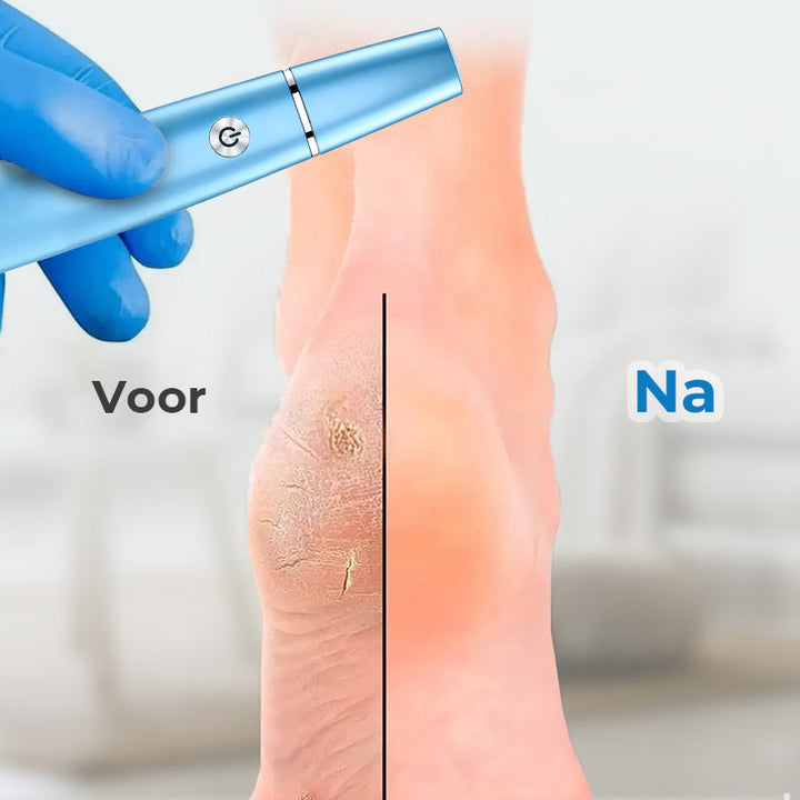 BowLift | SmoothFoot – Achieve silky smooth feet in just a few minutes