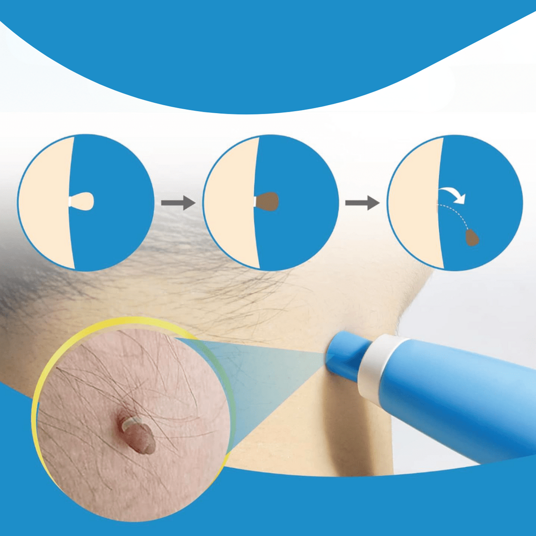 BowLift | WartAway – Remove warts, completely without chemicals!