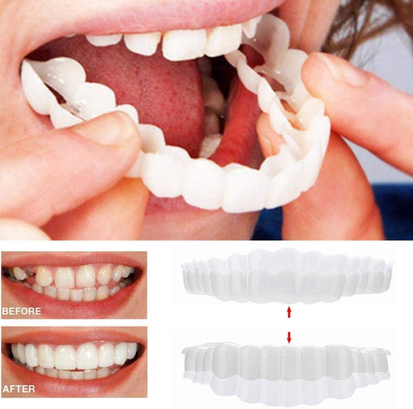 BowLift | On Smile Veneers (Upper and Lower Jaw included)