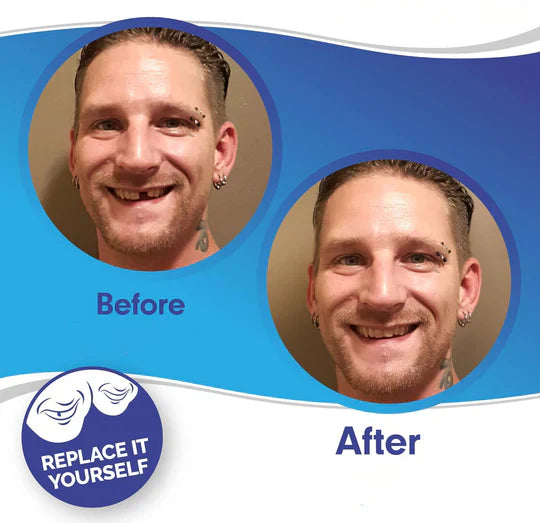 BowLift | Smile Veneer (Upper & Lower Included)