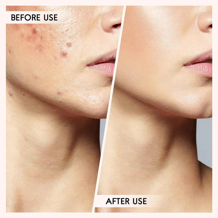 BowLift | Blackhead and pimple removal set