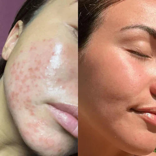 BowLift | LumiGlow - Pain-Free Treatment: Non-Invasive Therapy
