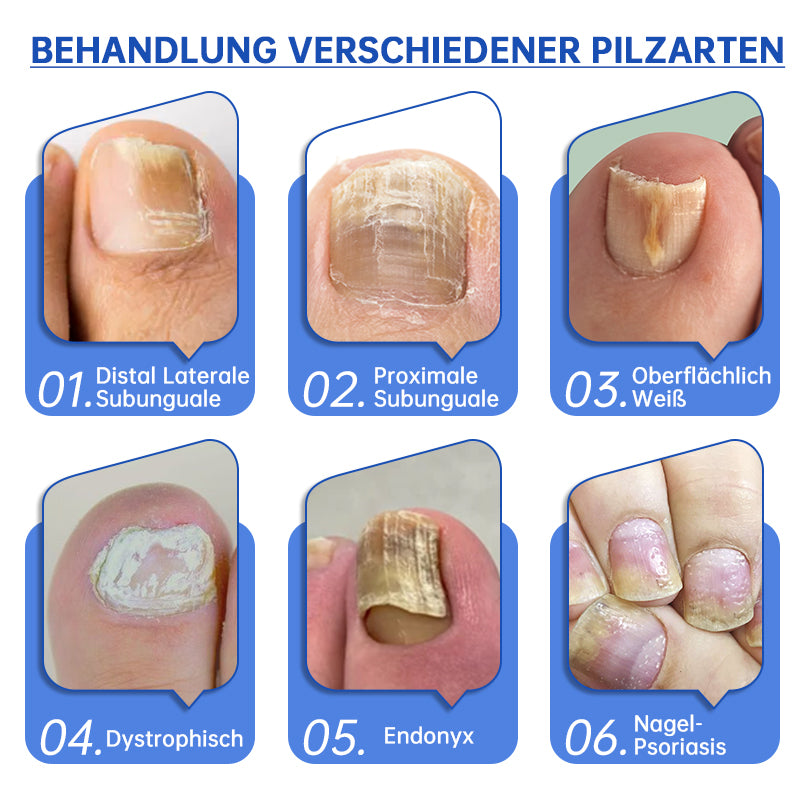 BowLift | PureNail™ | Nail Fungus Laser Therapy Device - Your Secret Weapon Against Nail Fungus
