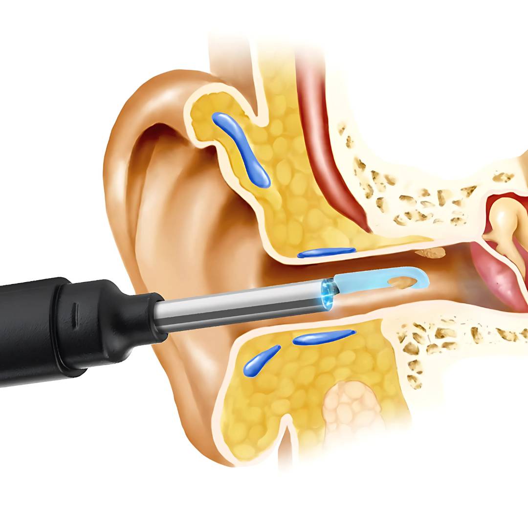 EarScope Pro - Smart Visual Earwax Removal Tool | LED Camera and Soft Tips - Safe and Precise Ear Cleaning Bowlift