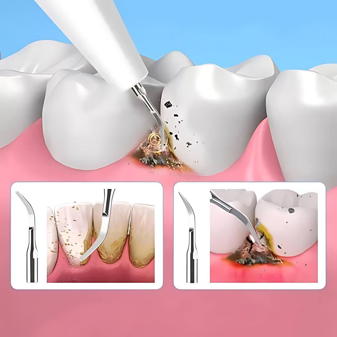 PlaqueFree Plaque Remover for teeth | Ultrasonic Teeth Cleaner - Tartar Remover from Home - Deep Teeth Cleaning and Polish Bowlift