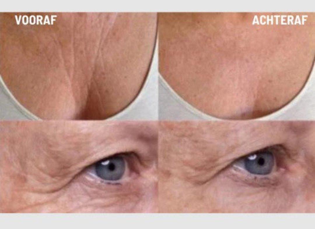 BowLift | Anti-Wrinkle Silicone Pads