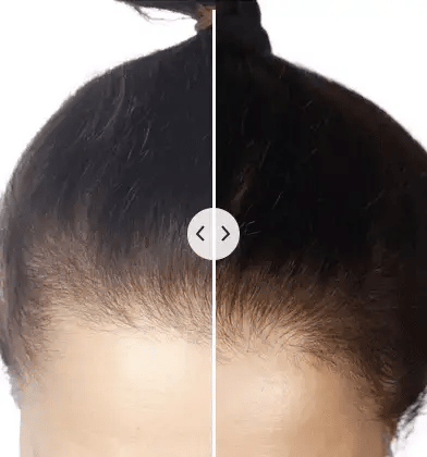 BowLift | 5-in-1 hair comb with massage & light therapy for healthier hair