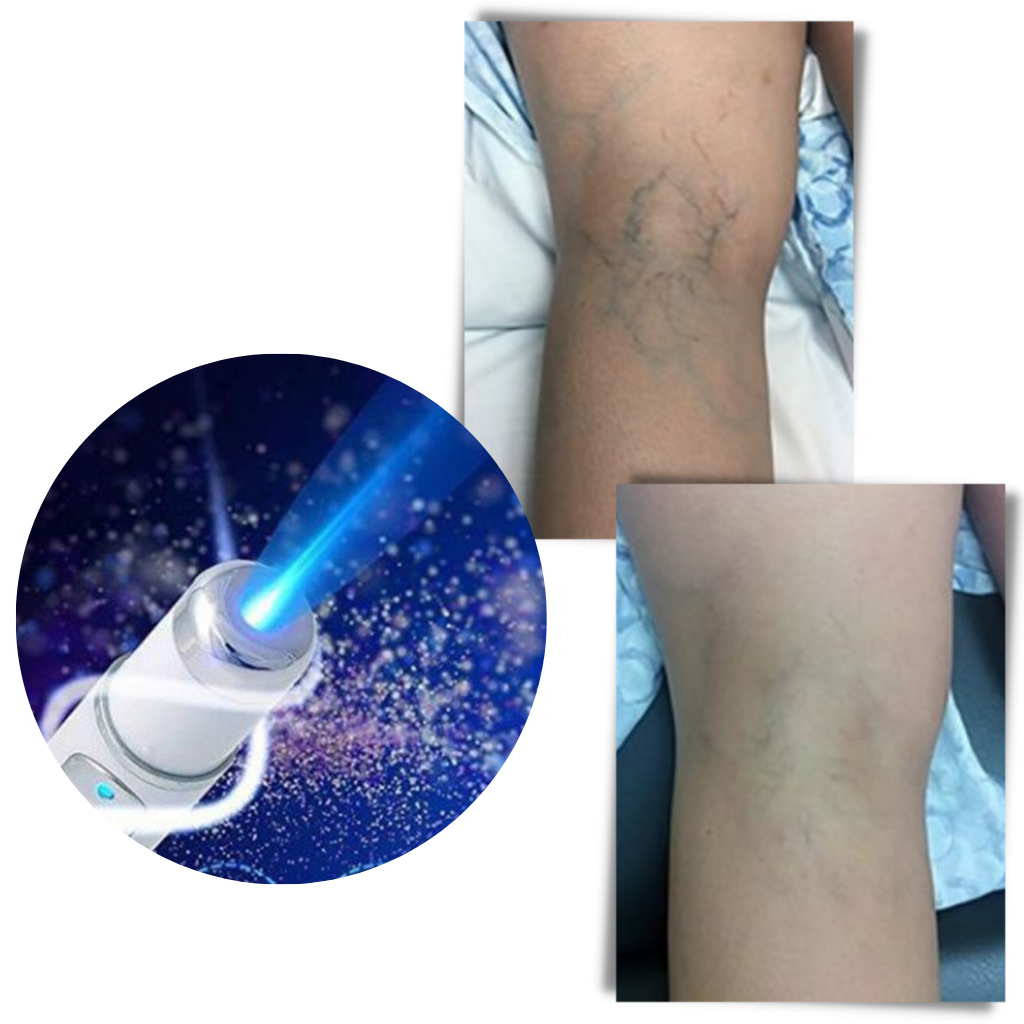 BowLift | Blue light skin therapy pen