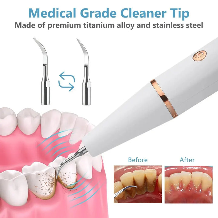 BowLift | Ultrasonic Teeth Cleaning Device | 38 kHz Ultrasound, LED Light & USB Fast Charging for Home Dental Care