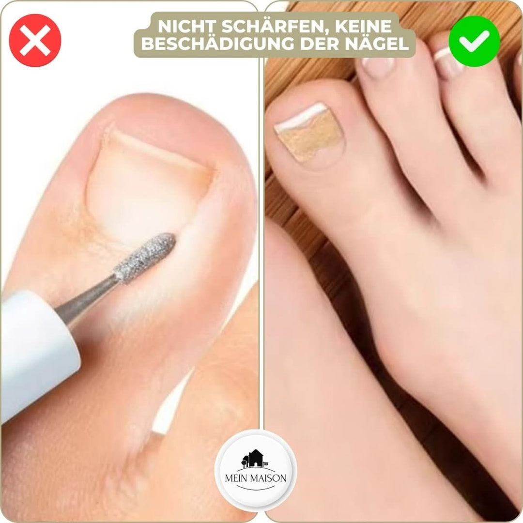 BowLift | FixaNail – Painless nail correction for ingrown & deformed nails