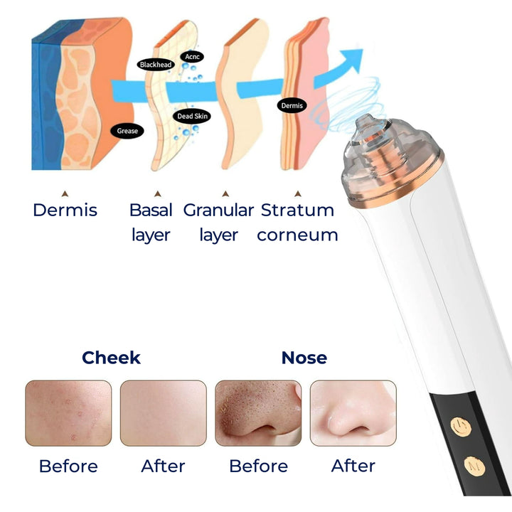 GlowEase | Microdermabrasion Kit – Blackhead Remover – USB Rechargeable – At-Home Skincare Solution Bowlift