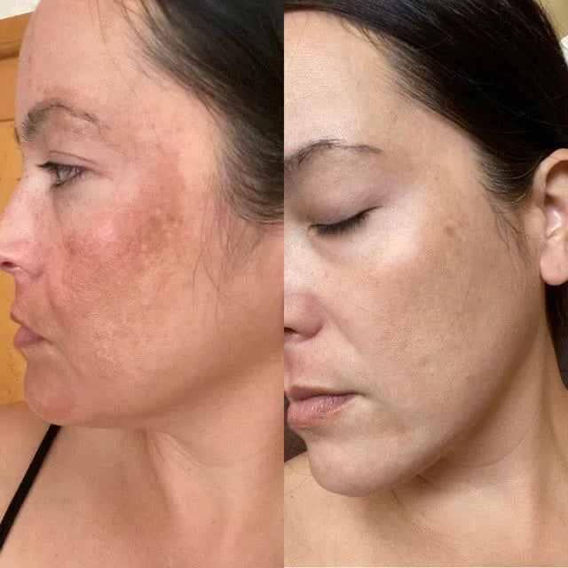 BowLift | LumiGlow - Pain-Free Treatment: Non-Invasive Therapy