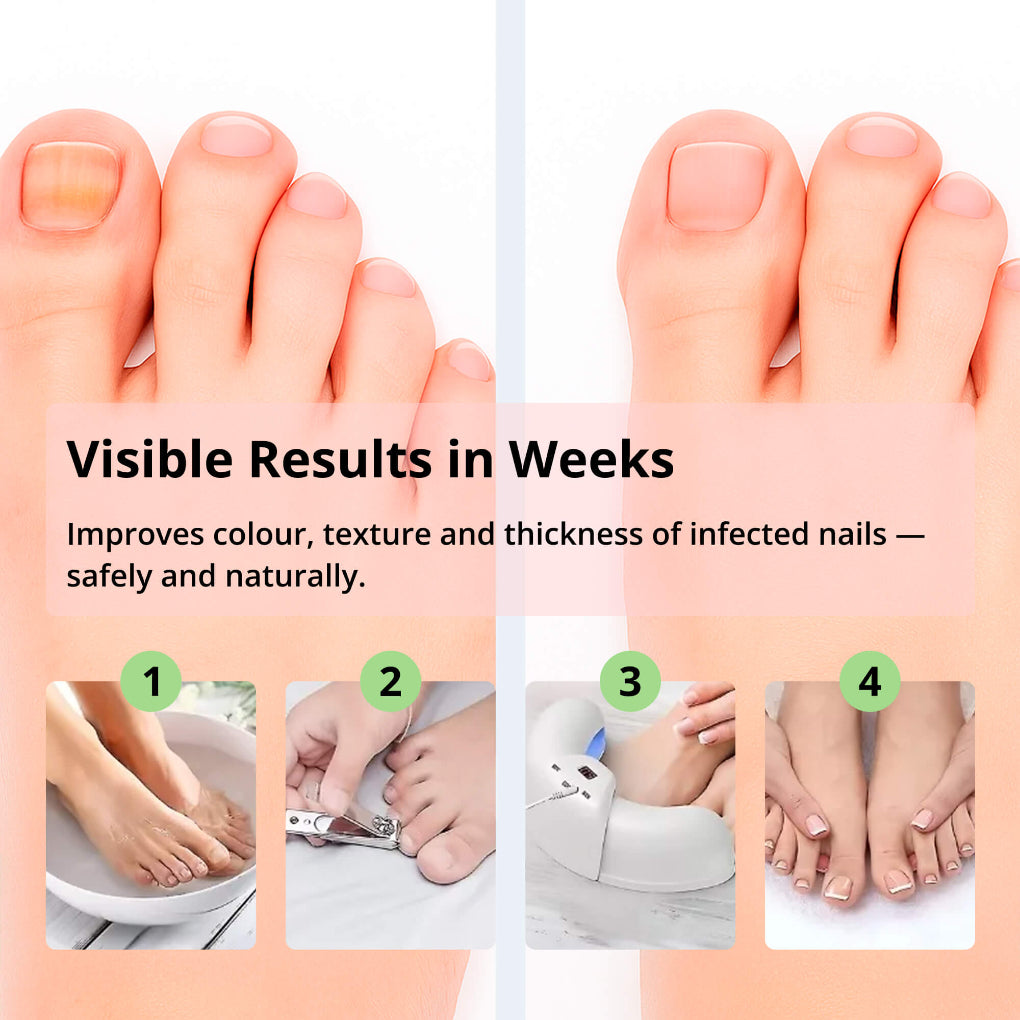Laser Nail Treatment Device – Red and Bowliftaulight against Nail Fungus | Bowlift