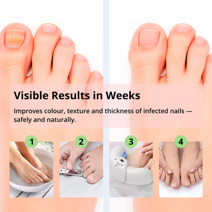 Laser Nail Treatment Device – Red and Bowliftaulight against Nail Fungus | Bowlift