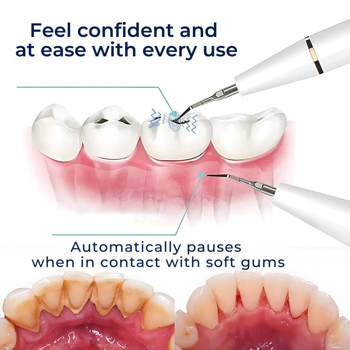 PlaqueFree Plaque Remover for teeth | Ultrasonic Teeth Cleaner - Tartar Remover from Home - Deep Teeth Cleaning and Polish Bowlift