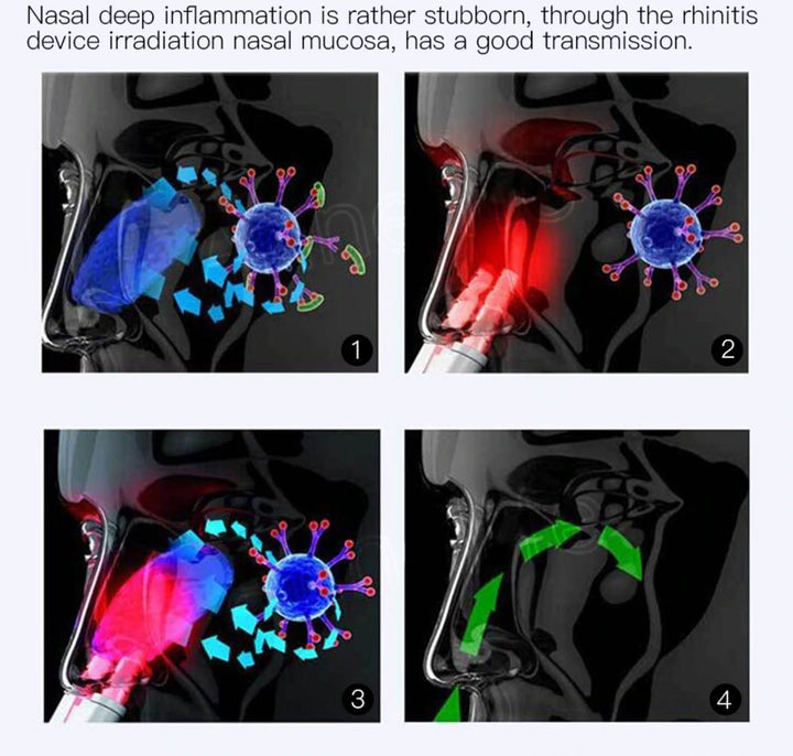 BowLift | Infrared Rhinitis Therapy Device