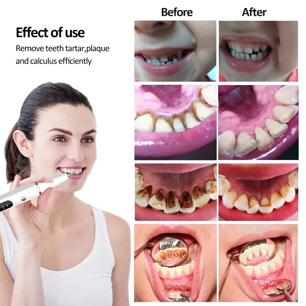 BowLift | Electric Dental Calculus Remover