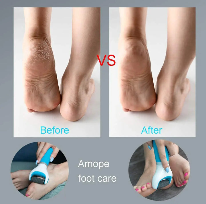 BowLift | USB Foot Callus Remover Pedicure Tool
