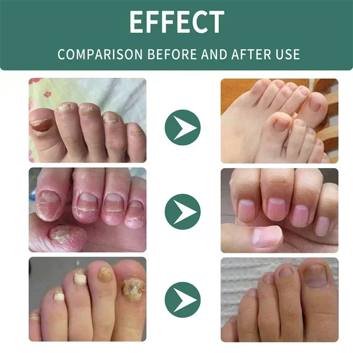 BowLift | Nail Fungus Defender Serum