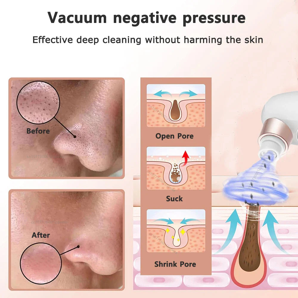 BowLift | Acne Black Head Deep Clean Removal
