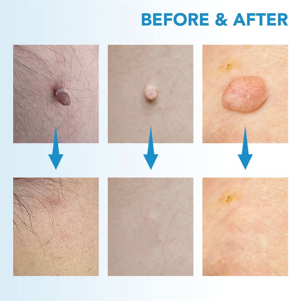 BowLift | Skin spot remover for warts & skin tags