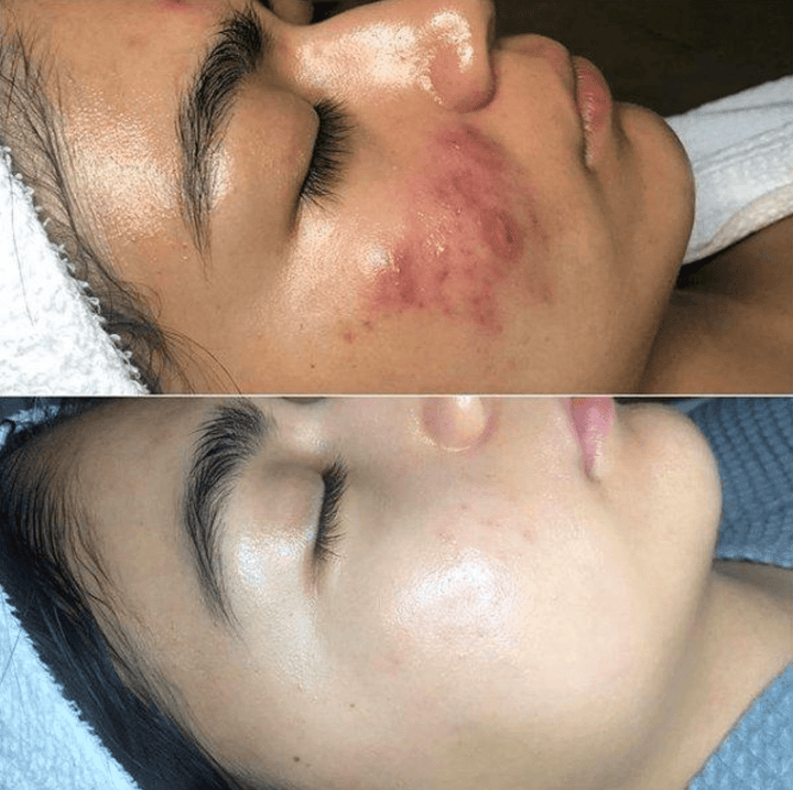 BowLift | Frendorf High Frequency Skin Therapy