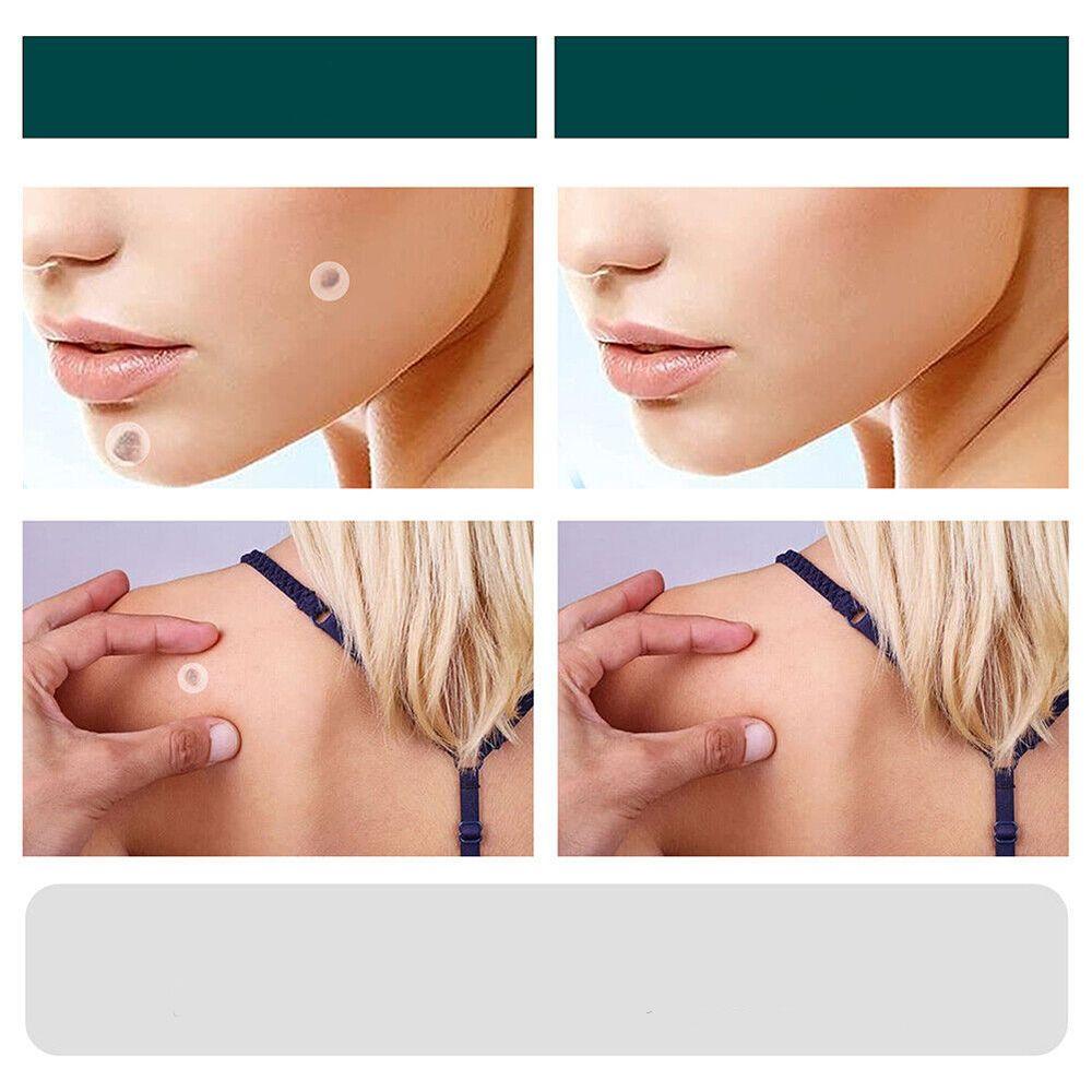 BowLift | SkinClear - Plaster for the removal of spots and warts