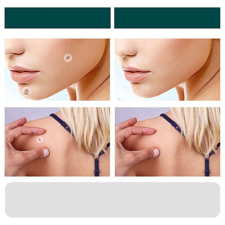 BowLift | SkinClear - Plaster for the removal of spots and warts