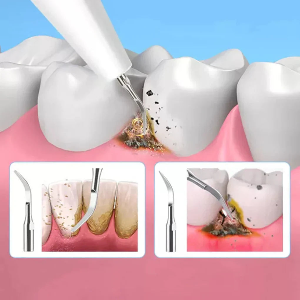 BowLift | Ultrasonic Tooth Cleaning Pro – Electric Tartar Remover for Home Use