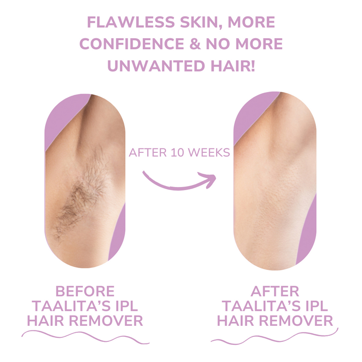 BowLift | SmoothWave™ IPL Hair Remover