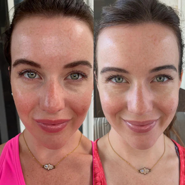 BowLift | LumiGlow - Pain-Free Treatment: Non-Invasive Therapy