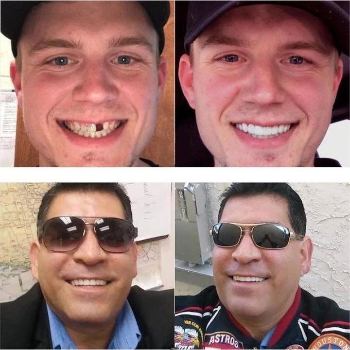 BowLift | Snap-On Dentures