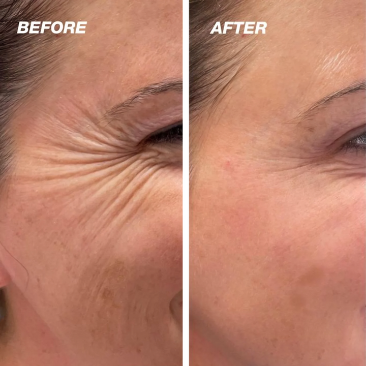 BowLift | LumeniSkin — Put an end to blemishes and radiate confidence!