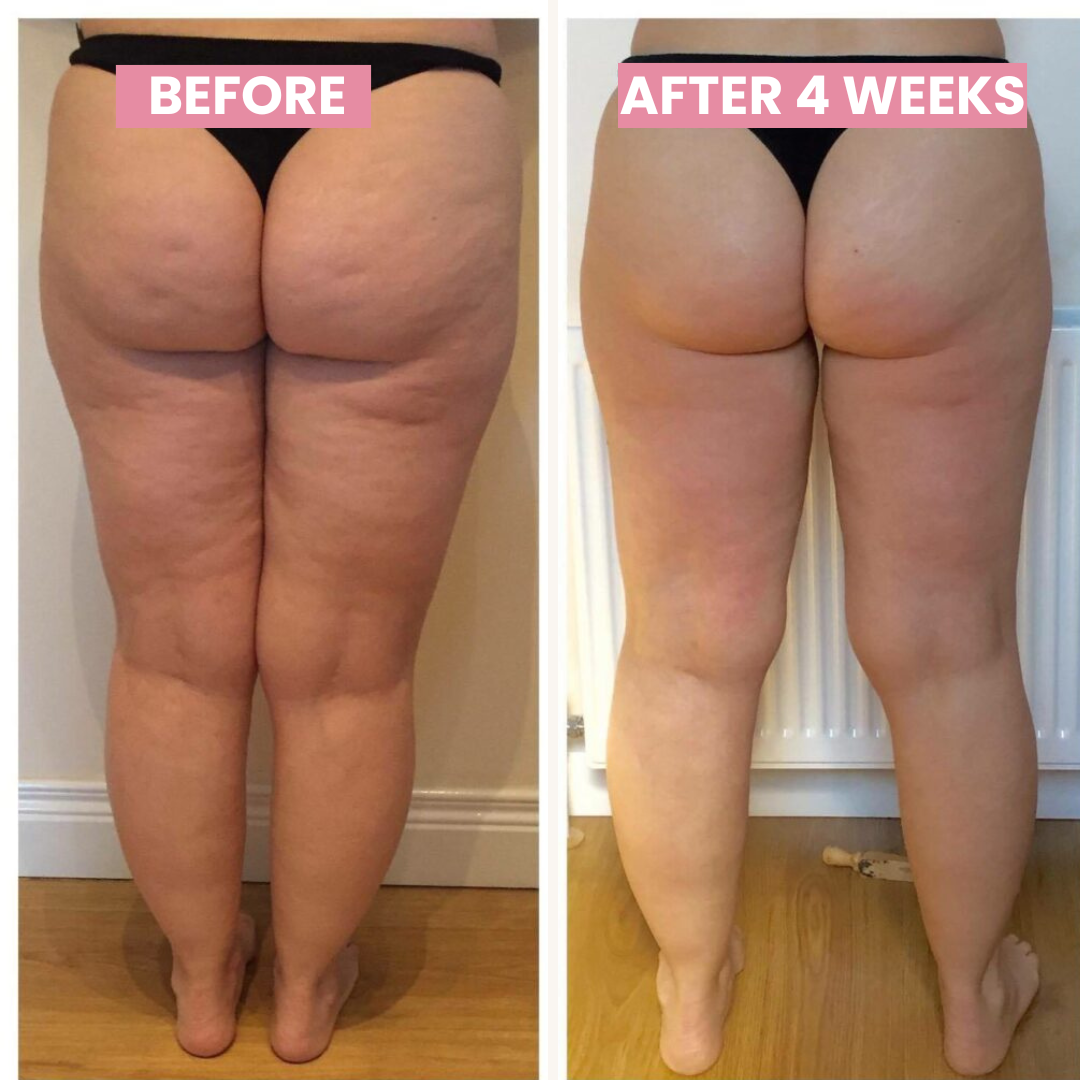 BowLift | Anti-cellulite Cupping Device - SlimCupp