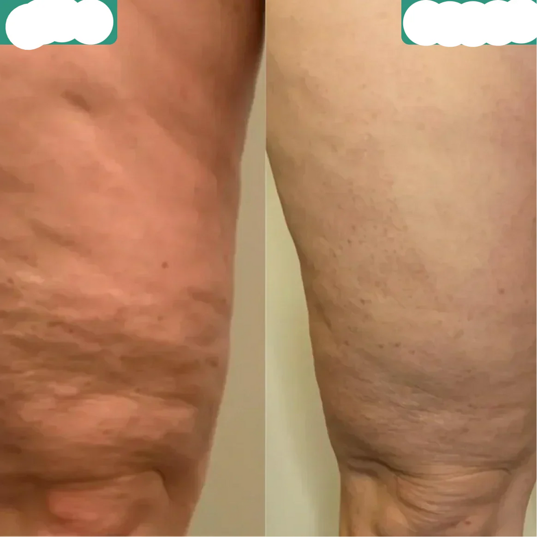 BowLift | Effective Cellulite Reduction and Skin Smoothing